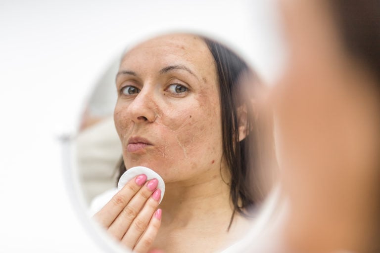 Is It Possible To Get Rid of Acne As A Teen? Crystal Ngozi Beauty