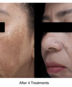 Laser Treatment Before & After Treatment result in Tucker, GA | Crystal Ngozi Beauty & Esthetics