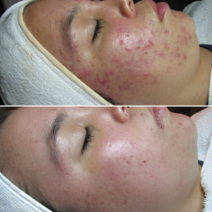 Skin-store Before & after Treatment result in Tucker, GA | Crystal Ngozi Beauty & Esthetics
