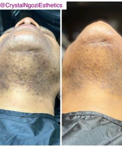 Laser Hair Removal Before & after treatment result in Tucker, GA | Crystal Ngozi Beauty & Esthetics
