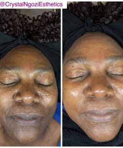 Microcurrent Face Lift 2 Microcurrent Face Lift Before and After