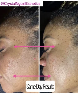 Microcurrent Face Lift 3 microcurrent-results-1