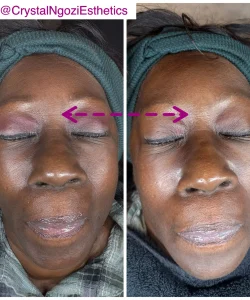 Microcurrent Face Lift 4 microcurrent-results-2