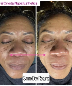 Microcurrent Face Lift 5 microcurrent-results-3