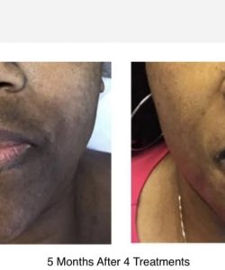 Laser Treatment Before & After Treatment result in Tucker, GA | Crystal Ngozi Beauty & Esthetics