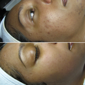 Skin-store Before & after Treatment result in Tucker, GA | Crystal Ngozi Beauty & Esthetics