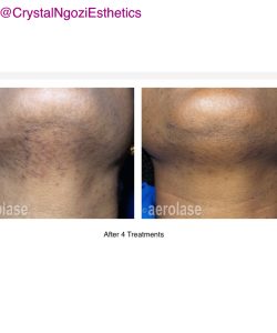 Laser Hair Removal Before & after treatment result in Tucker, GA | Crystal Ngozi Beauty & Esthetics